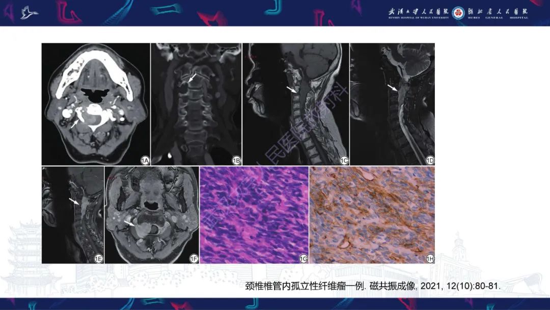 【PPT】椎管内孤立性纤维瘤/血管外皮细胞瘤影像诊断-18