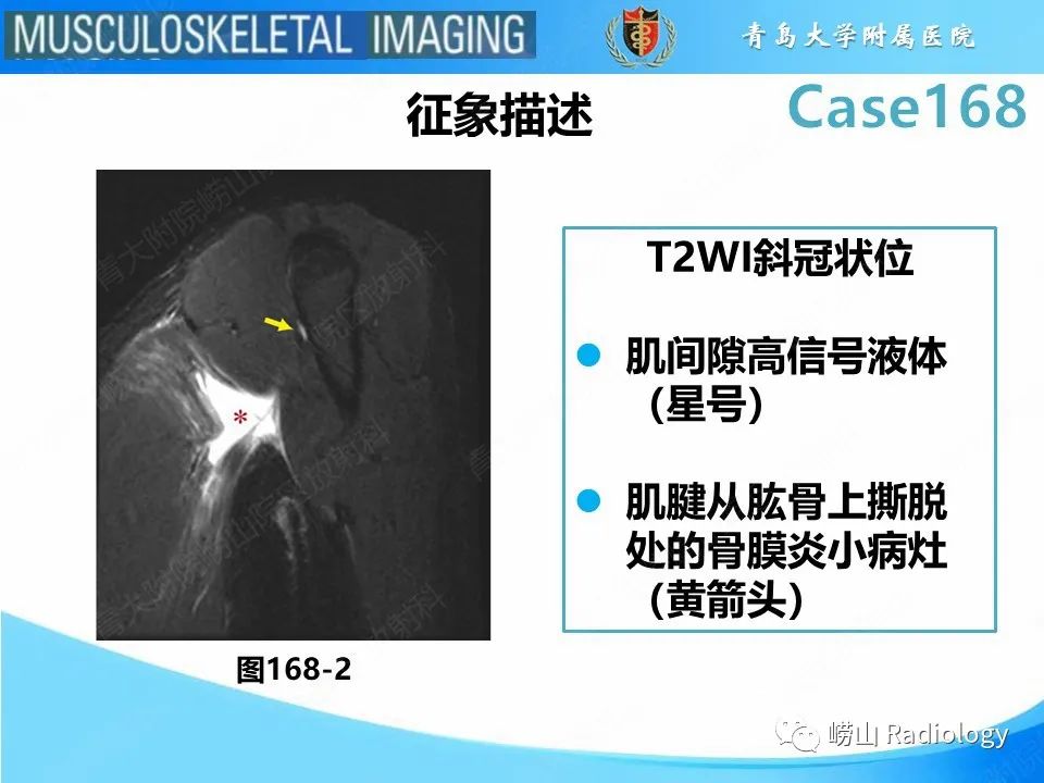 【PPT】胸大肌撕裂-18