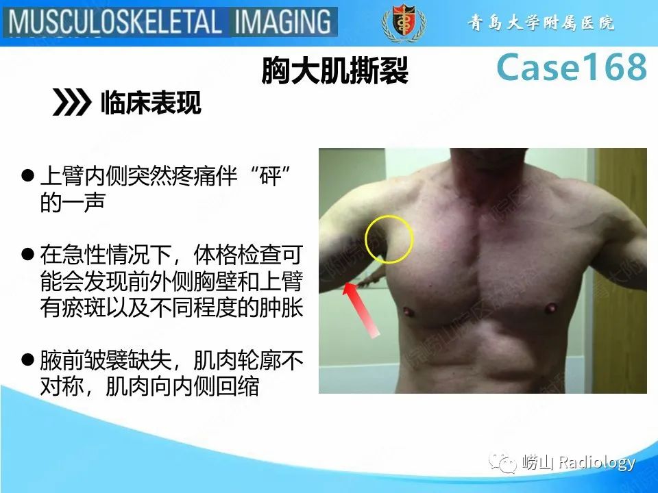 【PPT】胸大肌撕裂-14