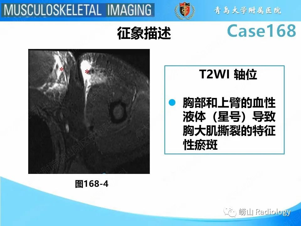 【PPT】胸大肌撕裂-20