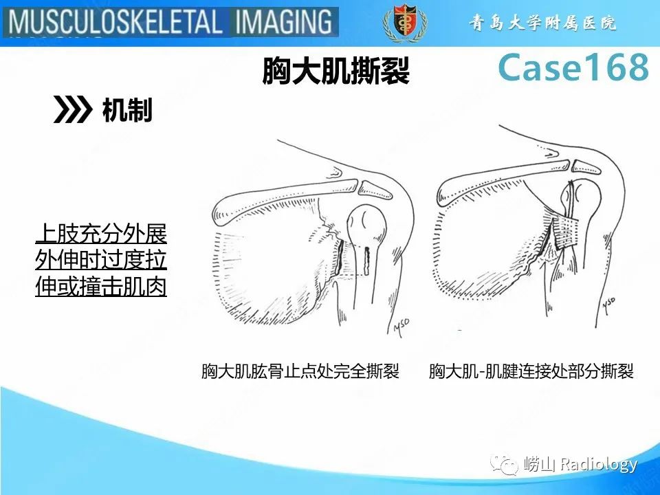 【PPT】胸大肌撕裂-13