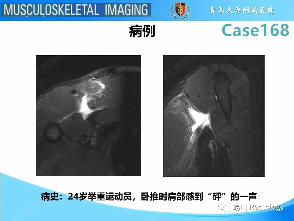 【PPT】胸大肌撕裂-2