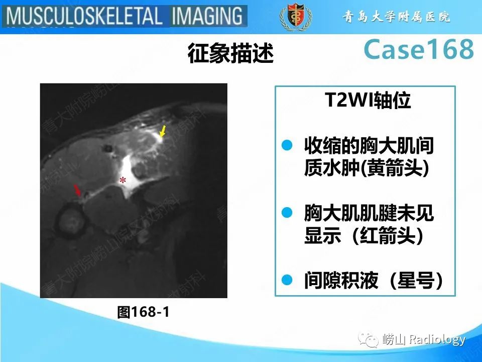 【PPT】胸大肌撕裂-17