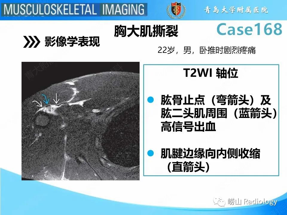 【PPT】胸大肌撕裂-16