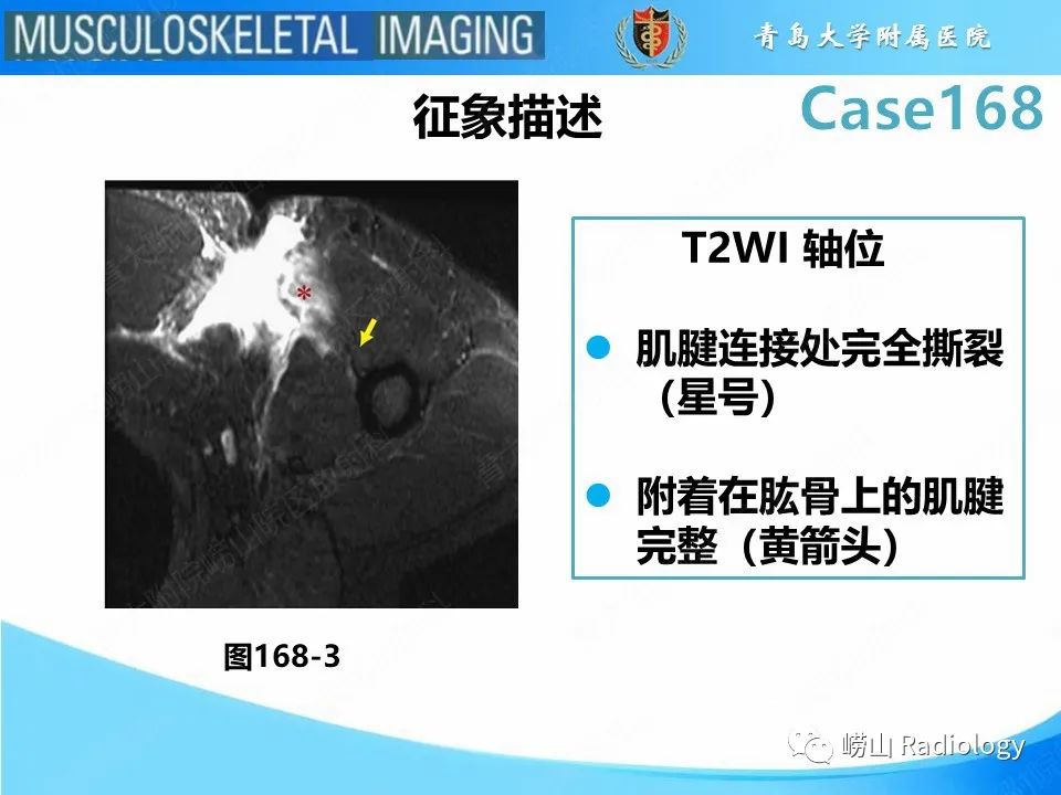 【PPT】胸大肌撕裂-19