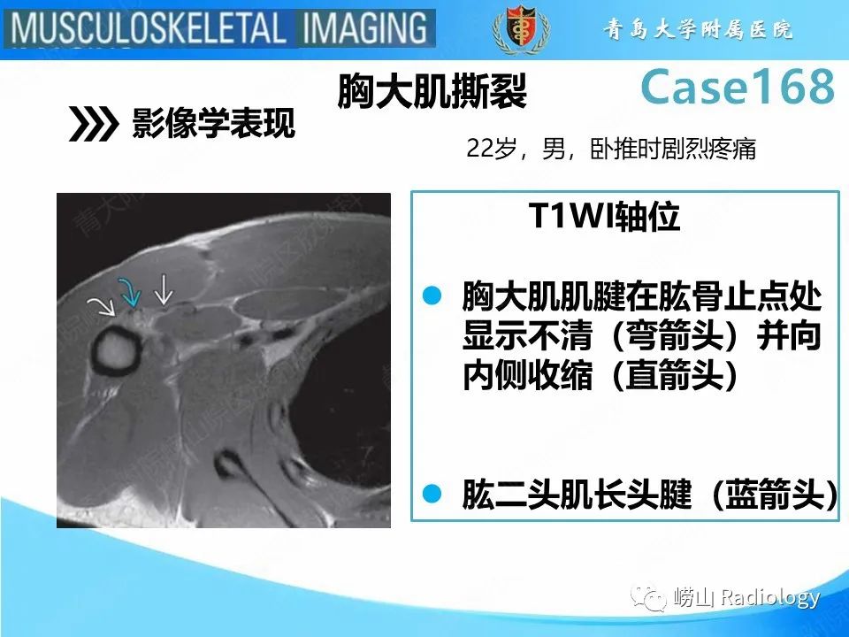 【PPT】胸大肌撕裂-15