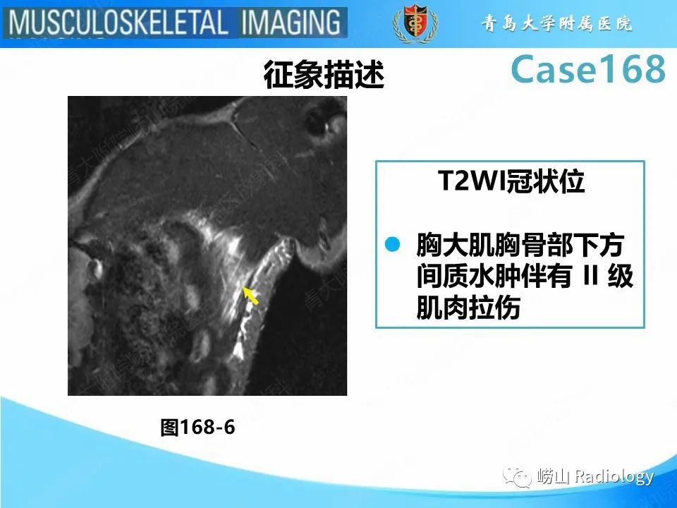 【PPT】胸大肌撕裂-22