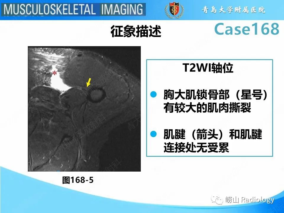 【PPT】胸大肌撕裂-21