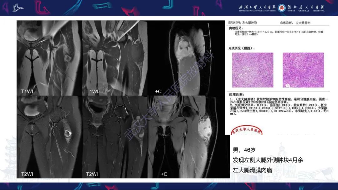 【PPT】骨外粘液样软骨肉瘤影像诊断-18