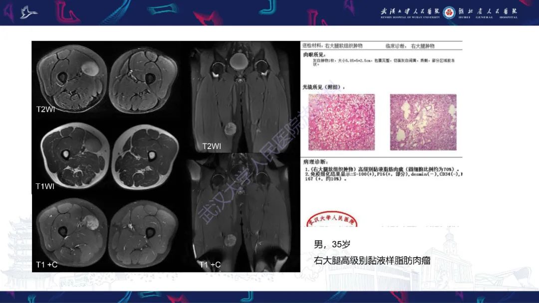【PPT】骨外粘液样软骨肉瘤影像诊断-23