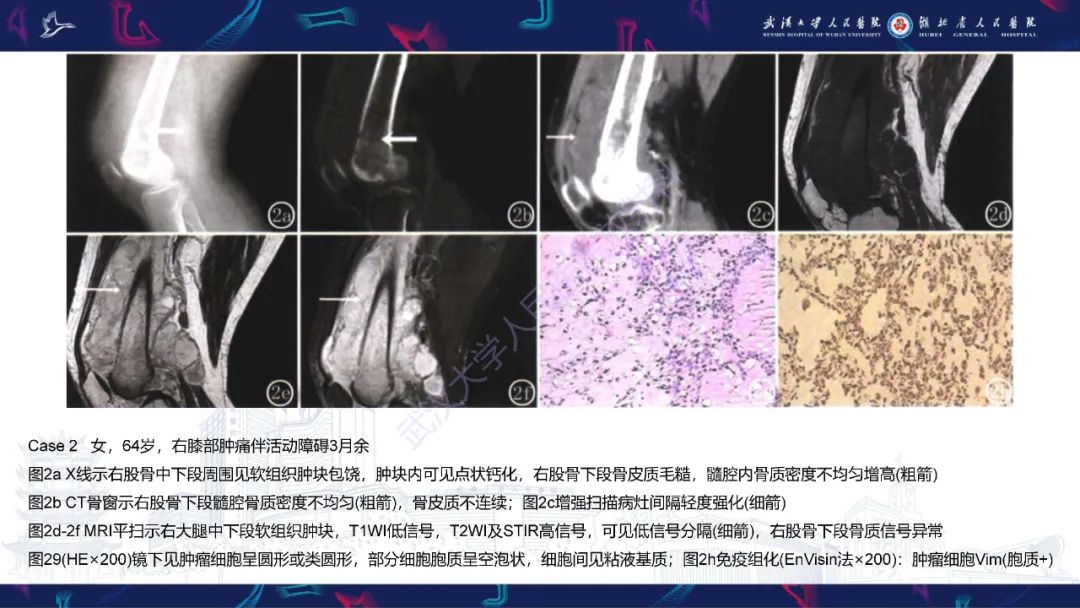 【PPT】骨外粘液样软骨肉瘤影像诊断-13