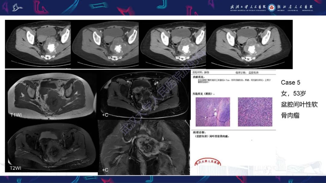【PPT】骨外粘液样软骨肉瘤影像诊断-16