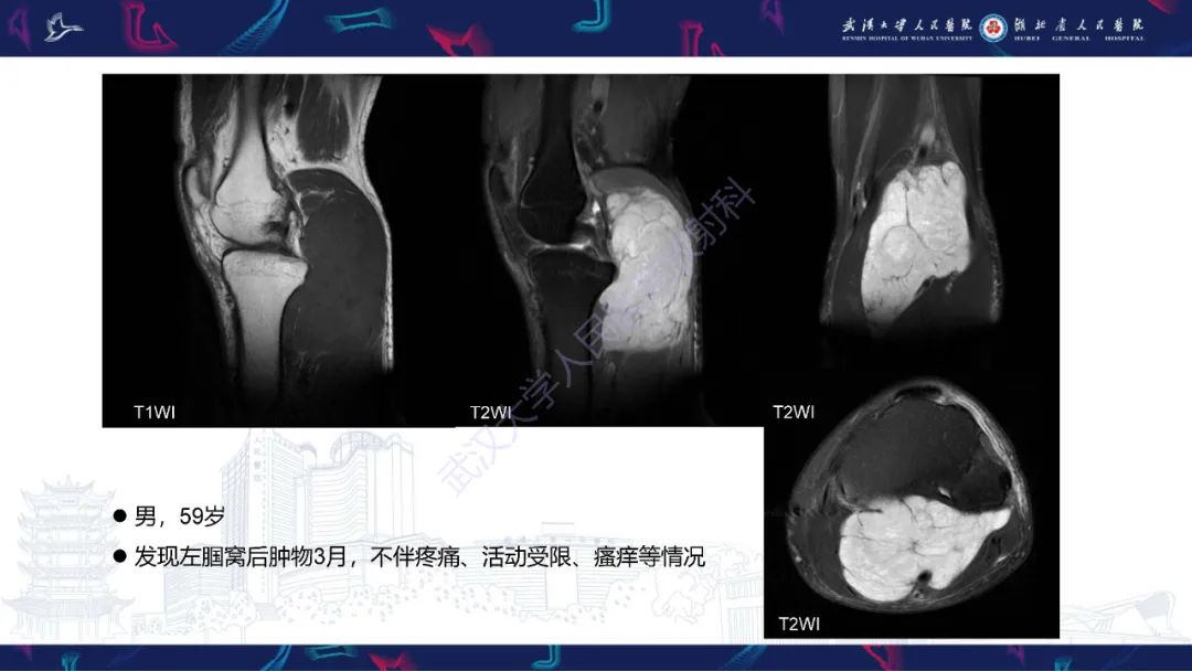 【PPT】骨外粘液样软骨肉瘤影像诊断-3