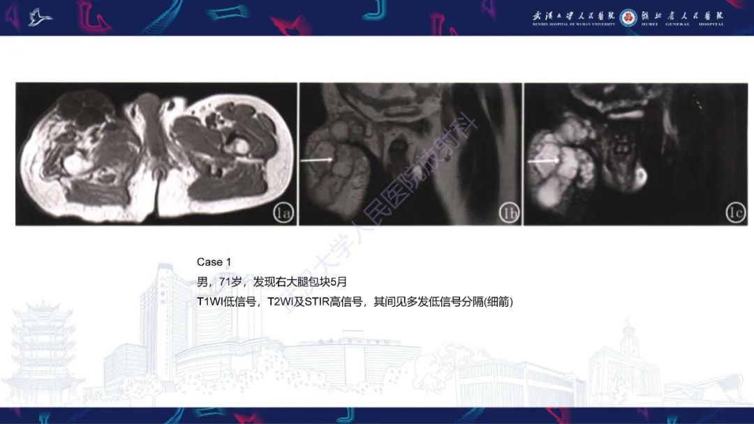 【PPT】骨外粘液样软骨肉瘤影像诊断-12