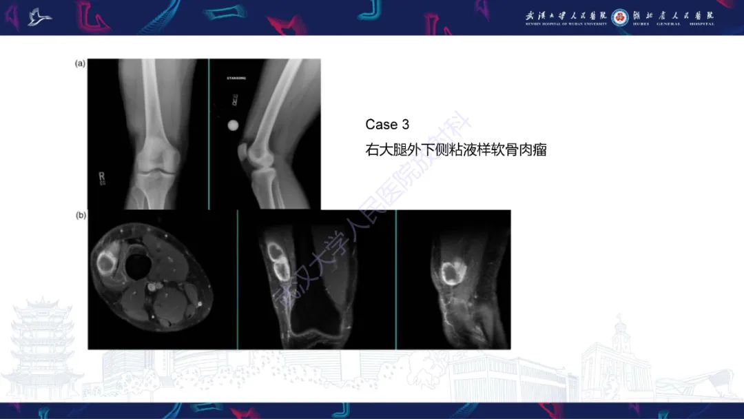 【PPT】骨外粘液样软骨肉瘤影像诊断-14