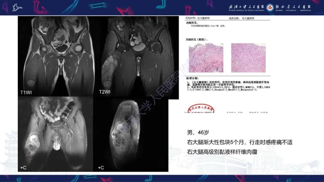 【PPT】骨外粘液样软骨肉瘤影像诊断-20