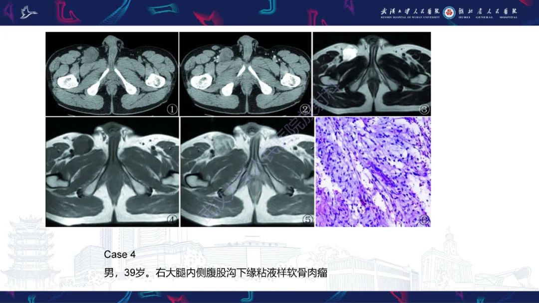【PPT】骨外粘液样软骨肉瘤影像诊断-15