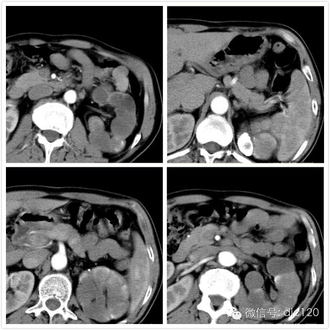 【典型病例】左肾结核CT病例(三期增强)影像诊断分析