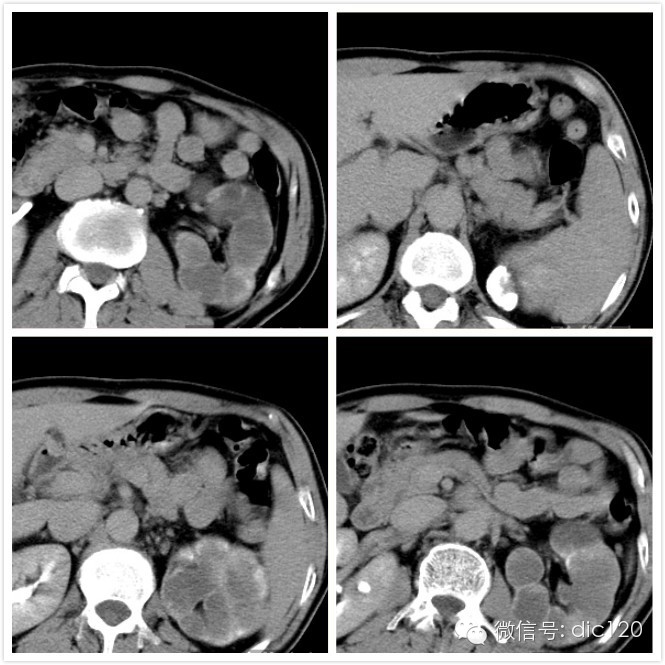 【典型病例】左肾结核CT病例(三期增强)影像诊断分析