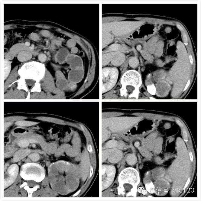 【典型病例】左肾结核CT病例(三期增强)影像诊断分析