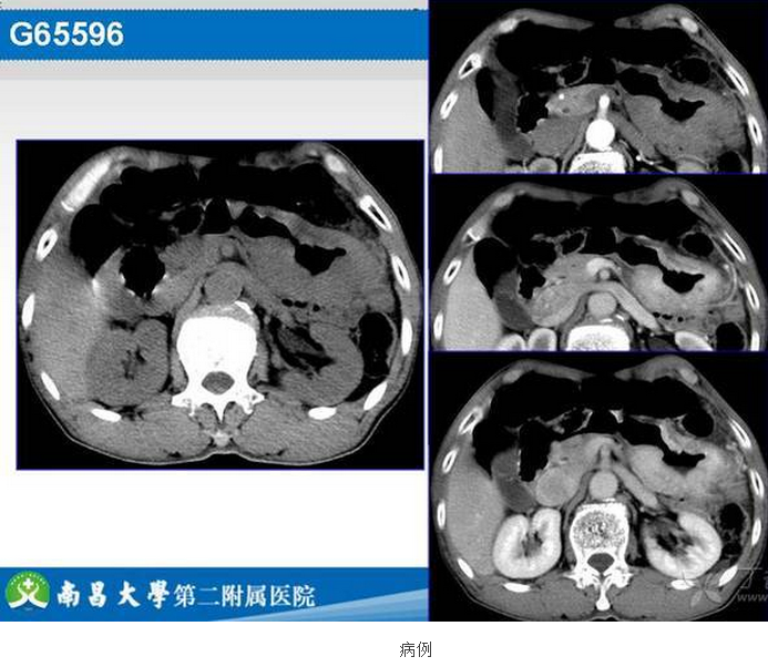 胃癌的 CT 诊断及 TNM 分期