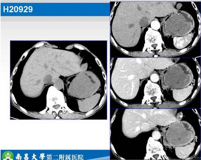 胃癌的 CT 诊断及 TNM 分期