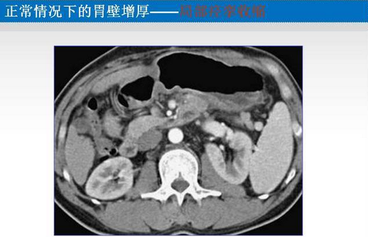 胃癌的 CT 诊断及 TNM 分期