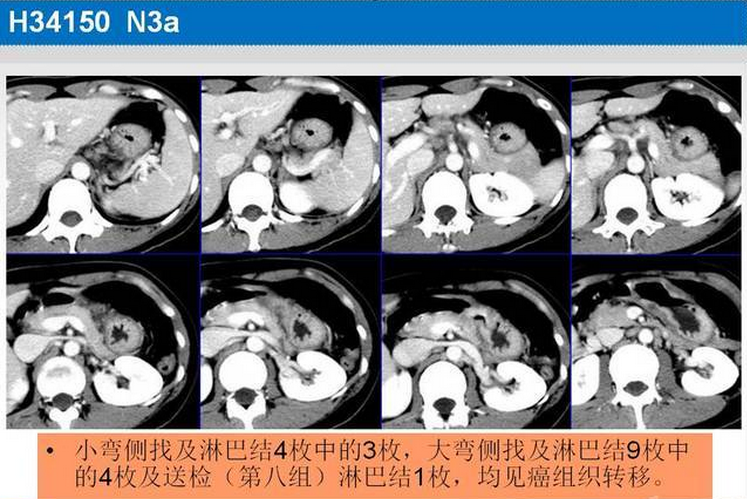 胃癌的 CT 诊断及 TNM 分期