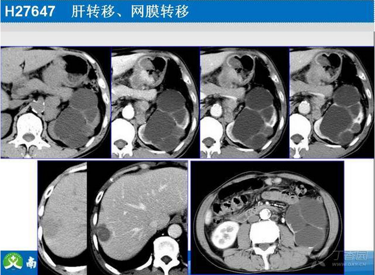 胃癌的 CT 诊断及 TNM 分期