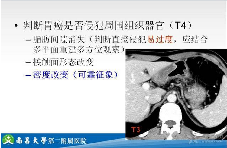 胃癌的 CT 诊断及 TNM 分期