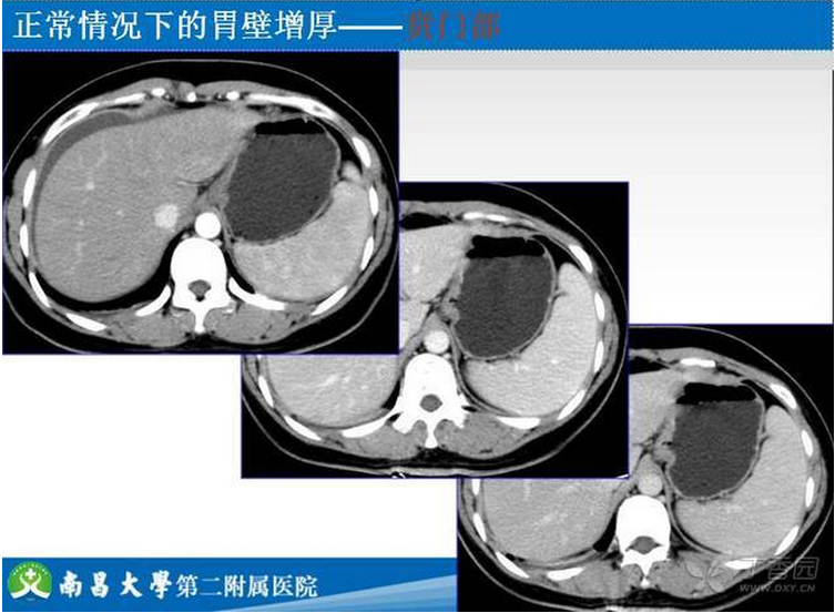胃癌的 CT 诊断及 TNM 分期