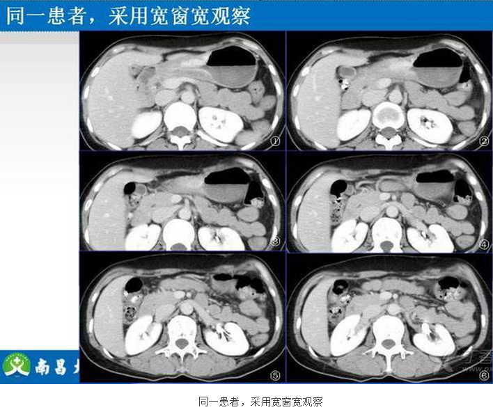 胃癌的 CT 诊断及 TNM 分期