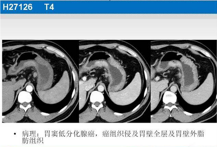 胃癌的 CT 诊断及 TNM 分期