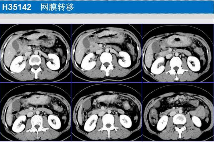 胃癌的 CT 诊断及 TNM 分期