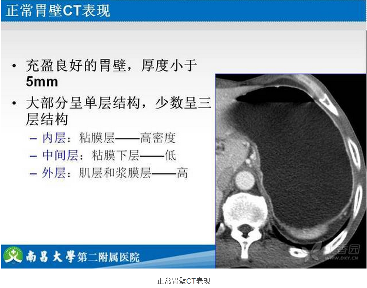 胃癌的 CT 诊断及 TNM 分期
