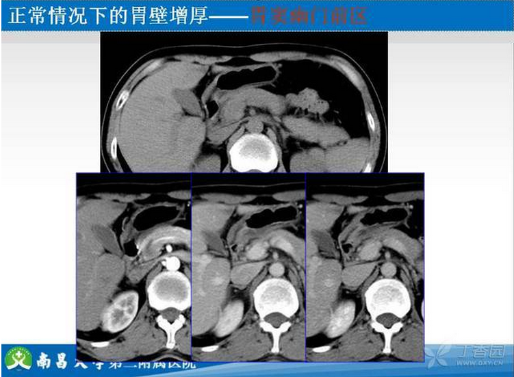 胃癌的 CT 诊断及 TNM 分期