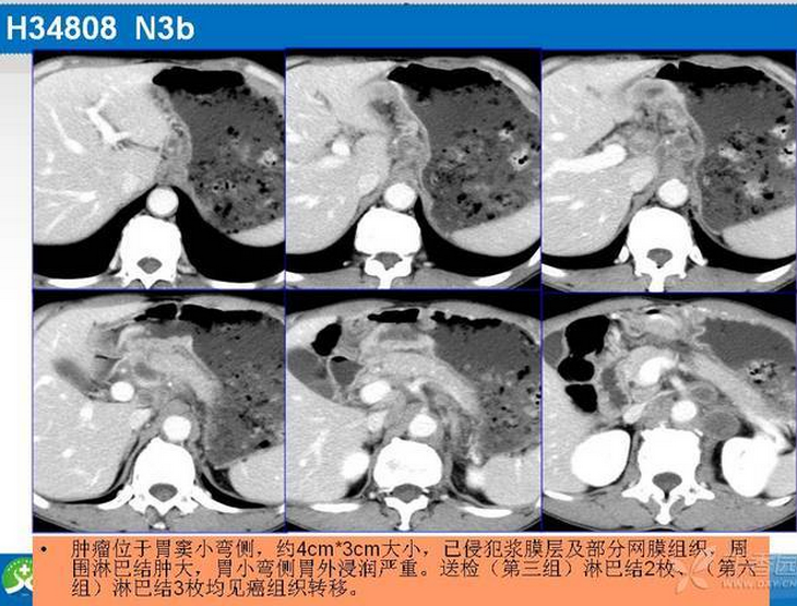 胃癌的 CT 诊断及 TNM 分期