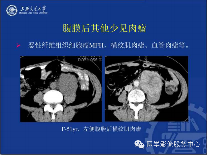 腹膜后间隙病变的影像诊断