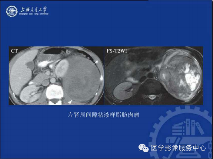 腹膜后间隙病变的影像诊断