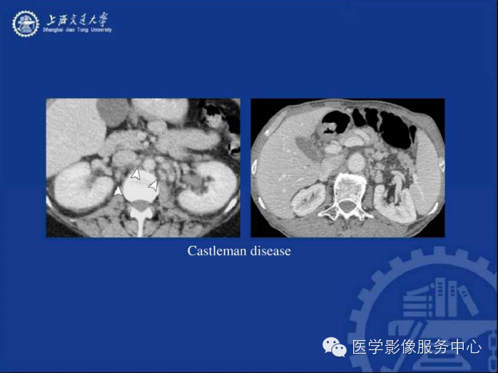 腹膜后间隙病变的影像诊断