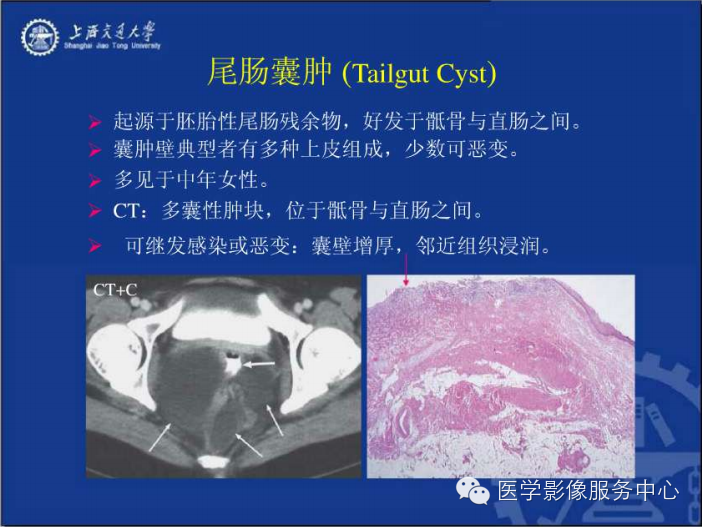 腹膜后间隙病变的影像诊断