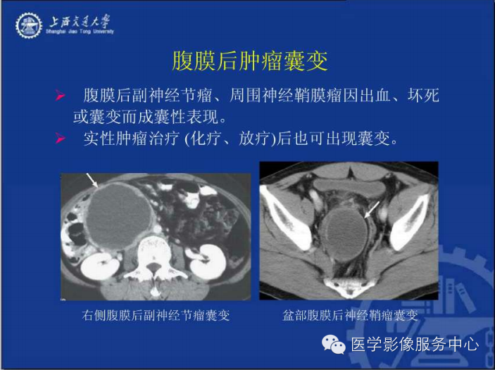 腹膜后间隙病变的影像诊断