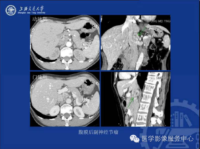 腹膜后间隙病变的影像诊断