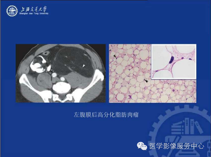 腹膜后间隙病变的影像诊断