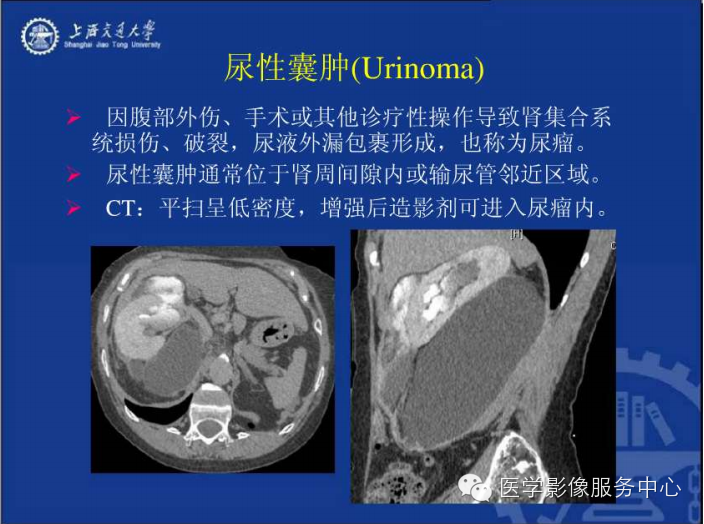 腹膜后间隙病变的影像诊断