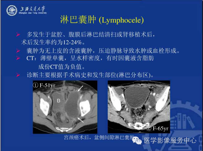 腹膜后间隙病变的影像诊断
