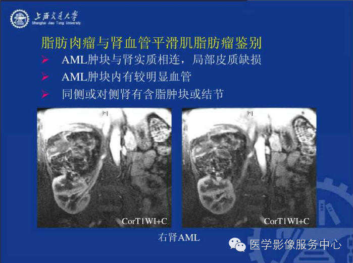 腹膜后间隙病变的影像诊断