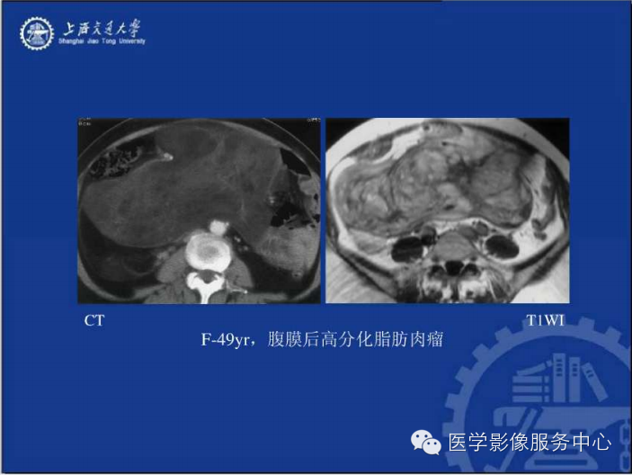 腹膜后间隙病变的影像诊断