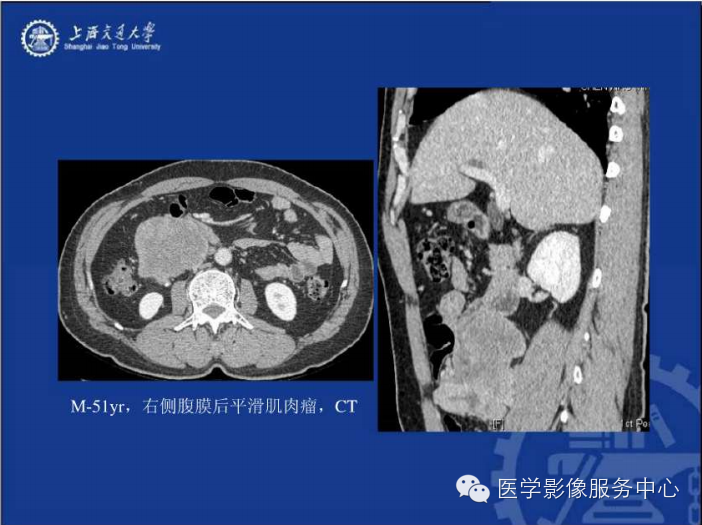 腹膜后间隙病变的影像诊断