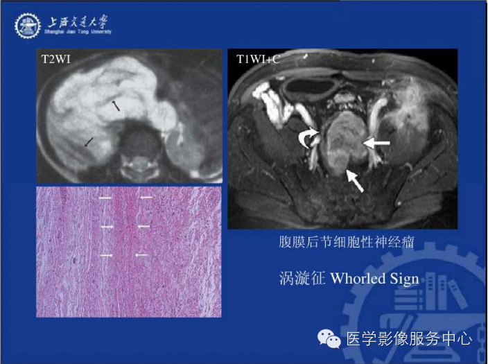 腹膜后间隙病变的影像诊断